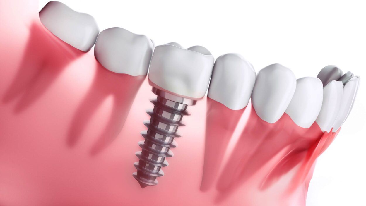 Implantes dentales precios 2023