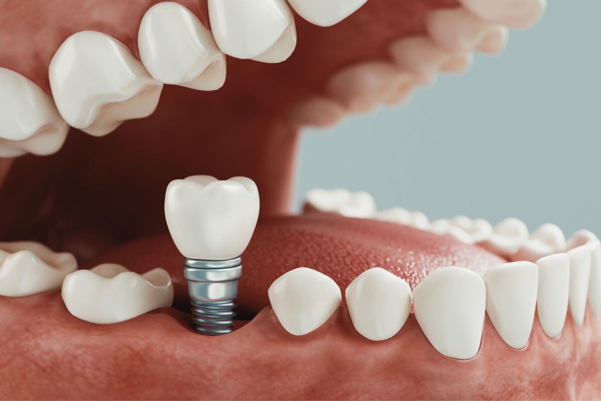 Implantes dentales precios 2023 ¿Cuánto cuesta en Argentina?