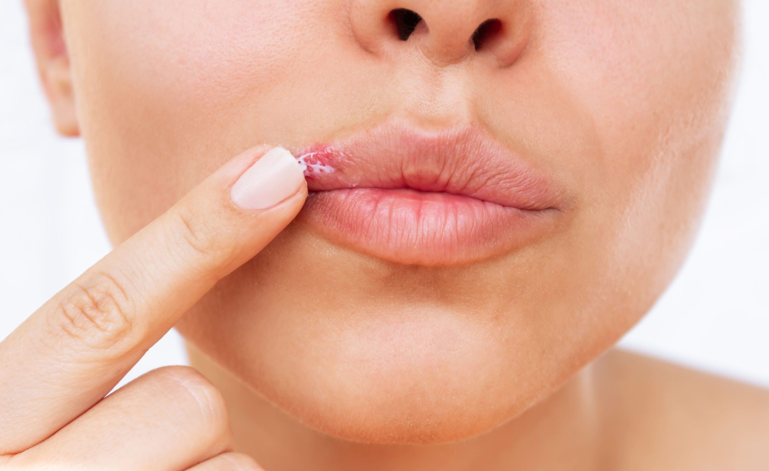 Que provoca el Herpes Labial las causas y como prevenirlo