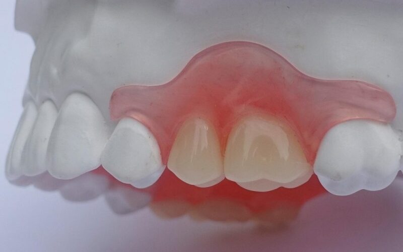 protesis parcial removible acrilica inmediata